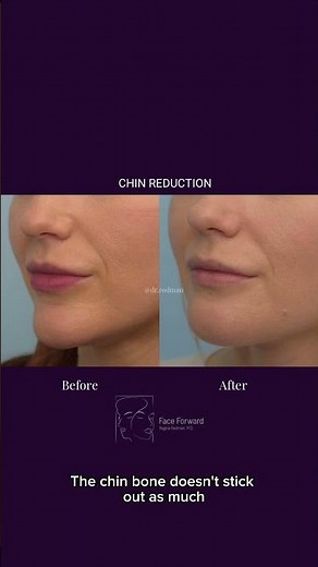 Chin Reduction| Reduction Genioplasty| Plastic Surgery
