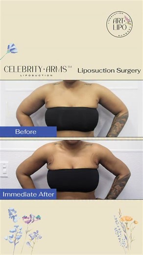 ArtLipo Liposuction & Lipedema Surgery on Instagram: "Celebrity Arms™ Liposuction in Tampa, Florida 🌟 Show the arms you’ve worked for. Dr. Thomas Su removes stubborn fat circumferentially (all the way around) and highlights your natural muscle shape—so triceps, delts, and biceps lines look clean and defined. @artlipo_lipedema_surgery @celebrityarmsliposuction Performed awake for real-time, artist-guided precision. 💪 Why it’s different • 360° high-definition sculpting (not “just fat removal”) •