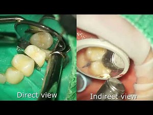 Direct vs Indirect View: Maxillary Premolar Inlay Preparation under Dental Microscope