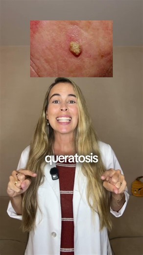 6 Skin Lesions Almost Everyone Confuses for a Wart