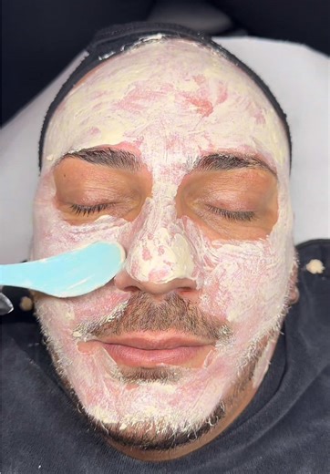 Microneedling Full Process Explained in Zurich