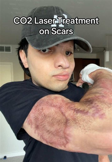 This is 7 days after CO2 laser treatment was performed. It is more effective on younger scars than older scars. #co2laser #burnsurvivor #sergioreyna #recovery