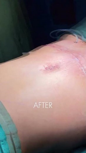 Abdominal Wall Repair & Contouring | Before–After by Dr Rajesh Vasu