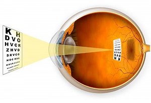 Science: The Real Cause Of Myopia