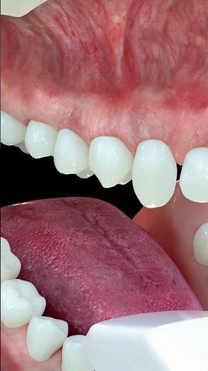 Video 3D Tratamiento de Invisalign - Ortodoncia invisible con taches