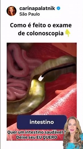EXAME DE COLONOSCOPIA: Como é o PREPARO, PARA QUE SERVE e RESULTADOS | CARINA PALATNIK