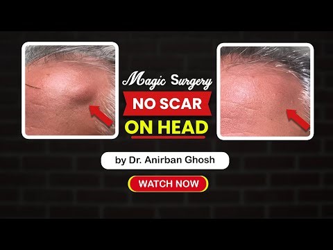 Scarless Lipoma Removal: Advanced Cosmetic Surgery Technique