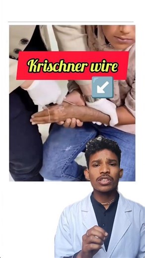 krischner wire