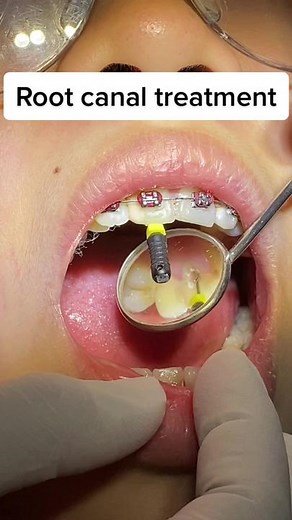 We want to save your badly decayed tooth! This is how root canal works, we use this file to clean the canal, take xrays and save your tooth 😊 patient felt 0% pain 💉😁 get your tooth saved now 🦷 #rootcanaltreatment #endodontics #phdentist #fyp #fypage