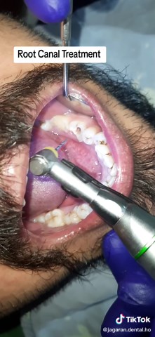 Root Canal Treatment Procedure Explained by Dr. Suman Kafle