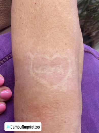 Camouflaging Scar from Laser Tattoo Removal