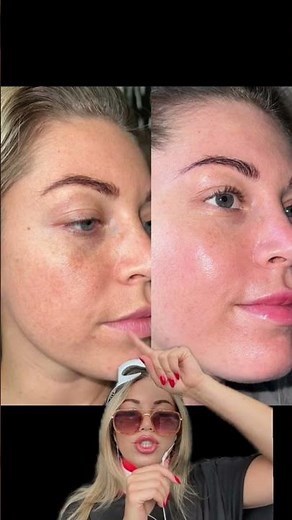 Red Light Therapy Mask before and after #ledmask #skincare