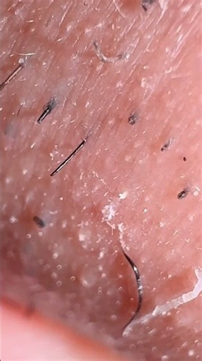 Deep Root Hair Extraction Clean Root Pull Video Ultra HD #Beardcare #Tweezing #ASMR #Macro #Root