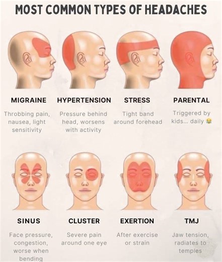 5.1K views · 25 reactions | Most Common Types of Headaches | Global Emergency Medical Technicians Registry | Facebook