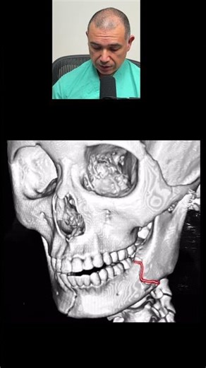 Mandible Fractures #shorts