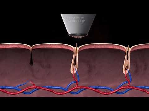 Comment fonctionne l’épilation laser? (Combien de séances?…pourquoi?)