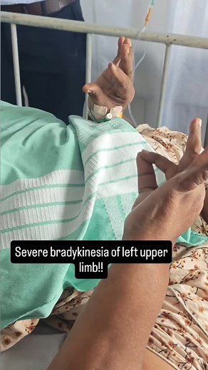 Dr M.Nirumal Khumar(Neuro nerd) on Instagram: "Finger tap test, which is used to assess bradykinesia in parkinson's disease patients. In the initial stages the amplitude is generally reduced f/b speed. You can see the left side is not tapping at all.. (Bradykinesia, finger tap test, parkinsonism, parkinson' s disease) #Neurology#BrainHealth#NeuroScience#Neurologist#NeurologyAwareness#BrainScience#Neuro#Neurology#Neurologist#NeurologyAwareness#BrainScience#NeurologicalDisorders#NeurologyEducation