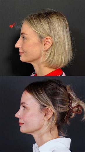 Rhinoplasty Before and After | Rhinoplasty Turkey