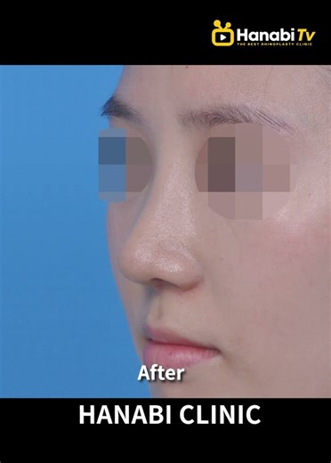 [Hanabi TV] Long nose rhinoplasty before and after, Seoul, Korea
