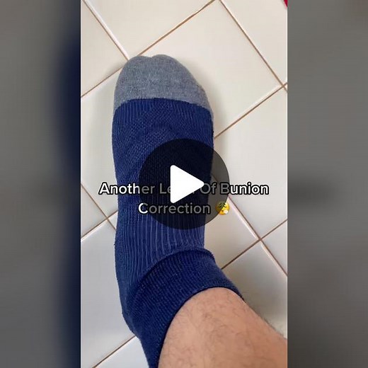 #bunioncorrector #halluxvalgus #toe #bunion