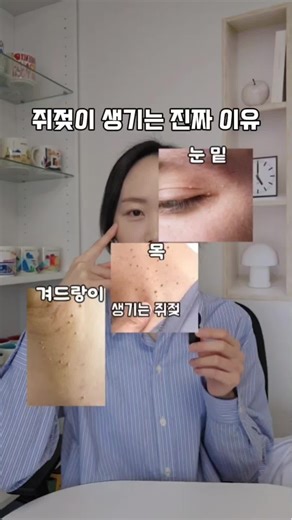 ⚠️쥐젖이 생기는 진짜 이유⚠️ 목, 겨드랑이, 눈 밑에 자꾸 생기는 작은 쥐젖… 혹시 그냥 피부 문제라고 넘기고 계신가요? 사실 쥐젖은 단순한 피부 변화가 아니라, 혈당 불균형과 인슐린 저항성이 원인일 수 있어요. 즉, 쥐젖 = 당뇨의 전조 증상일 수 있다는 뜻입니다. 그래서 약사슴이 주목한 성분은 바로 🌿바나바잎 추출물 – 혈당 안정화에 도움을 주는 자연 유래 성분! 그리고 여기에 더해 카테킨 – 체중 조절까지 도와주는 성분까지 담긴 3중 기능성 제품을 어렵게 구해왔어요. ✔️ 혈당관리 ✔️ 체중관리 ✔️ 콜레스테롤 한 번에 챙기고 싶으시다면, 댓글에 '쥐젖' 이라고 남겨주세요✍️ 공동구매 시작 전에 좋아요 알림으로 먼저 안내드릴게요! #쥐젖 #인슐린저항성 #혈당관리 #바나바잎 #카테킨 #당뇨전조증상 #당뇨전단계 #다이어트영양제 #공동구매 #알림