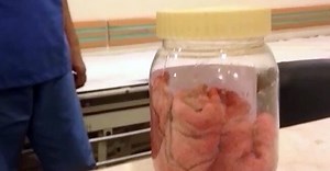 Fortis Hospital shocker: Cotton roll left inside stomach during surgery