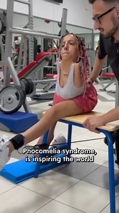 Influencer Nadia Lauricella, who was born with Phocomelia Syndrome, is inspiring the world with her fitness journey. According to St Louis Children’s Hospital, Phocomelia Syndrome is a birth defect in which the limbs are extremely shortened so that the feet and hands arise close to the trunk. Phocomelia can also be responsible for the absence of pelvic and thigh bones. In Nadia’s case, she has both arms missing, with a curved spine and uses one prosthetic leg. | PinkNews