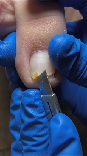 Ingrown Toenail Removal #toenailremoval #ingrowntoenail | Ingrown Toenails