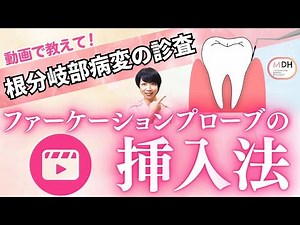 【歯科衛生士さん必見】上下大臼歯のファーケーションプローブの挿入法