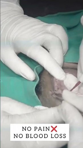 Lip Reduction Surgery Before & After Results | Rejuvena Cosmo Care Jaipur | Dr. Deepesh Goyal