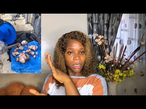 My Recovery From a 6 Hrs Myomectomy Surgery