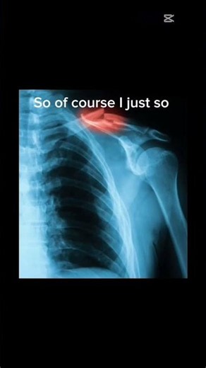 Broken collarbone (day 3. Read my comment for information)