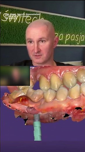 FROM ABSCESS TO NEW TOOTH! 🦷💎 Dentist: HOW I DESIGN A CROWN ON AN IMPLANT!