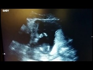 Watch a Baby Clapping in Rhythm During Ultrasound!