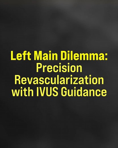 A middle-aged patient presented with moderate ischemic symptoms and borderline left main and proximal LAD disease — a classic gray-zone between bypass and PCI. IVUS assessment confirmed significant disease in both segments, meeting guideline-recommended criteria. We proceeded with IVUS-guided left main stenting across the LCx ostium, achieving excellent expansion and no residual disease. It was a smooth, precise procedure — a blend of evidence, imaging, and teamwork. Grateful to Dr. Roshan Paran