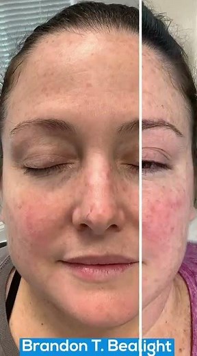 Blue Light Treatment Before & After | Treating Age Spots | Painless Blue Light Treatment St. Louis