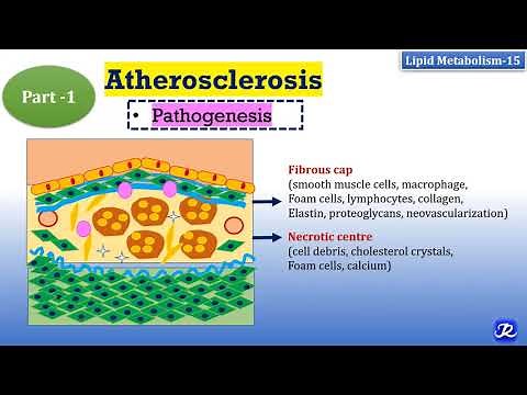 15: Atherosclerosis: Part-1(Pathogenesis-Major events)| Lipid Metabolism-15 | Biochemistry