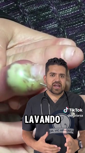 Infecciones por Morderse las Uñas: Paroniquia