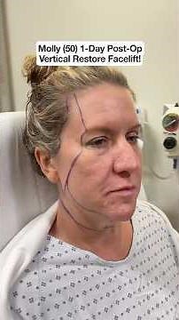 Her Vertical Restore Facelift Recovery Update! 🤗