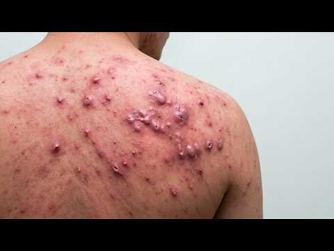 Loan Nguyen Acne Treatment 2kk