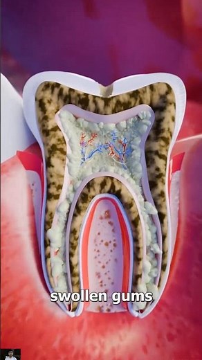 How Does a Tooth Infection Occur? Main Causes of Abscess and Pus Formation