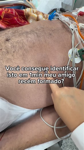 Dra Daniela Jaldin | MÉDICA 🩺 on Instagram: "Se a resposta for ‘não sei’... esse vídeo pode salvar vidas (inclusive a sua como médico). 🩺 O que é o choque ? CHOQUE = é a expressão clínica da hipoperfusão celular aguda causada pela incapacidade do sistema circulatório de suprir as demandas celulares de oxigênio do corpo. 🚨 É altamente ameaçadora à vida 🚨 Atenção: hipotensão não é sinônimo de choque!(Embora caminhem normalmente juntos). 📌 Tipos de choque? Choque hipovolêmico: há redução do vo