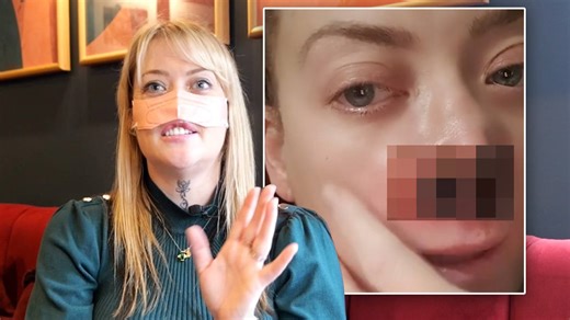 Flesh-eating virus leaves mum without a nose after Turkey teeth horror | LBC