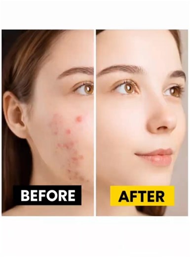 Remove Pimples and Acne | Photoshop Tutorials | #shorts