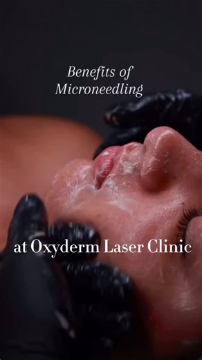 Your skin remembers how to heal — microneedling just reminds it 🧬✨ Those tiny micro-channels? They activate your skin’s wound-healing response, signaling fibroblast cells to produce fresh collagen and elastin (the stuff that keeps skin bouncy and smooth). Fun science fact: collagen production can increase for weeks after microneedling — meaning your glow keeps building long after the appointment is over 👀✨ Smoother texture. Softer lines. Faded scars. Better absorption of your skincare. No shoc