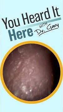 Massive Earwax Blockage Removed Curette & Irrigation = CLEAN EARS VLOG #102