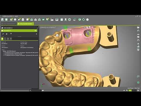 DWOS - Create an implant model