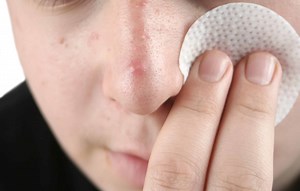 How To Prevent Pimples On Nose, According To Dermatologists!