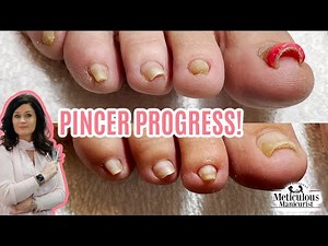 Pincer Toenail Pedicure Transformation Progress