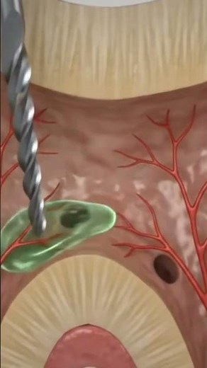 Root Canal Treatment (RCT) Explained | Save Your Tooth Without Extraction 🦷